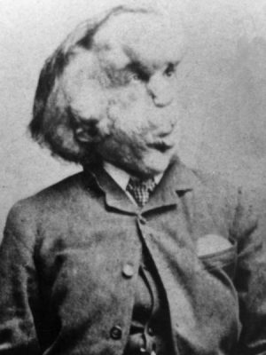 Joseph Merrick